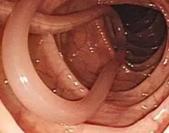 Parasita no intestino